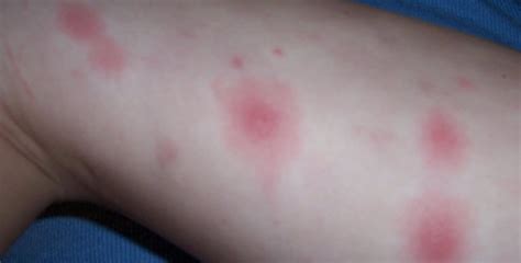 Maybe you would like to learn more about one of these? Erythema chronicum migrans - Zdravlje