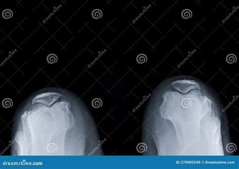 X Ray Image Of Both Normal Patella Stock Image Image Of