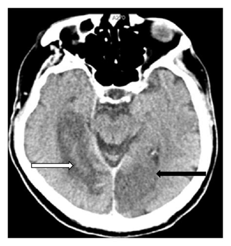 An Axial Ct Image Of The Brain Shows Subacute Cerebral Infarction In