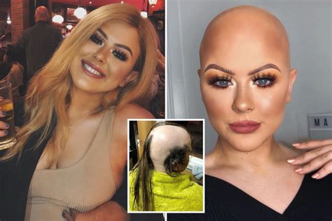 🙌 Make Up Artist Who Was Diagnosed With Alopecia At 16 And Tried To Cover Her Bald Spots With