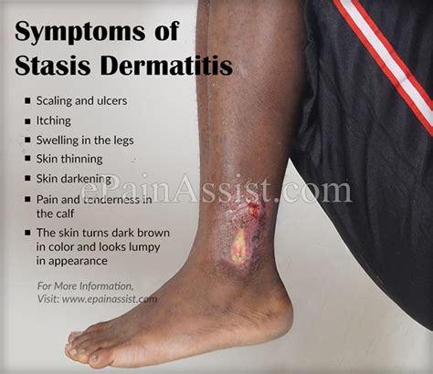Venous Stasis Ulcer Treatment Pictures Causes Symptoms