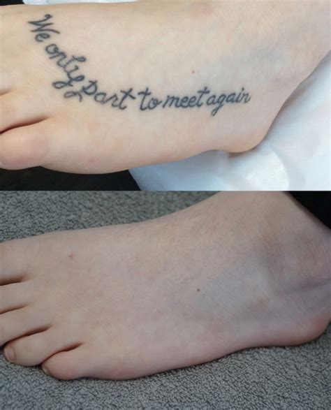 How many treatments are needed? Tattoo Removal - 207 LASER™ advanced LASER practice