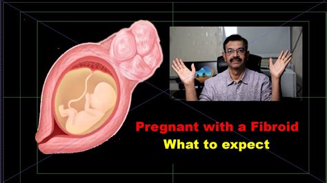 Pregnant With Fibroid What To Expect Youtube