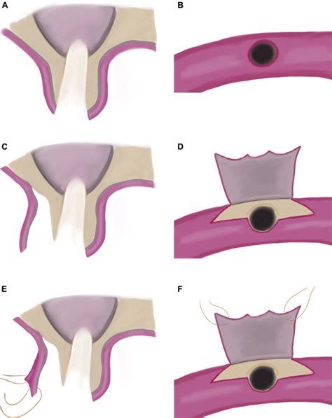 Inverted Periosteal Flap: An Alternative to the Buccal ...
