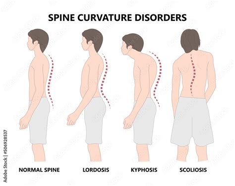 Spine Forward Head Posture Chest Xray Neck Pain Lumbar Scheuermanns