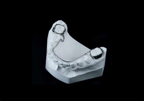 Fixed Bilateral Space Maintainer German Zahn Dental Lab