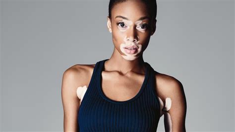 Model Chantelle Winnie Has A Skin Condition Vitiligo — And A Top