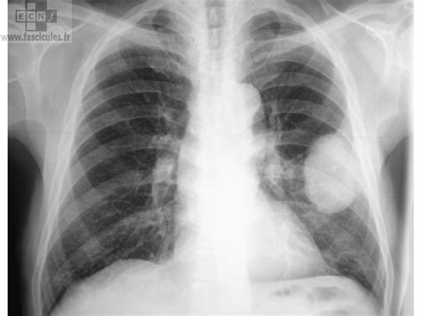 Le cancer du poumon est l'un des cancers les plus fréquents. 1) le cancer