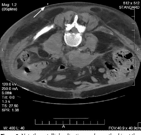 Figure 1 From Ct Guided Intra Abdominal Abscess Drainage Semantic