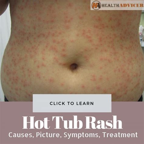 Hot Tub Rash Causes Picture Symptoms And Treatment