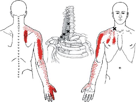 Figure 23 From Chapter 2 Myofascial Pain Syndrome Semantic Scholar