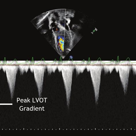 Transthoracic Echocardiogram A Parasternal Long Axis View Demonstrates