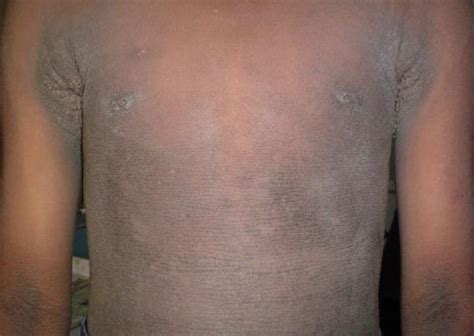 Acanthosis Nigricans Causes Symptoms Treatment And Pictures