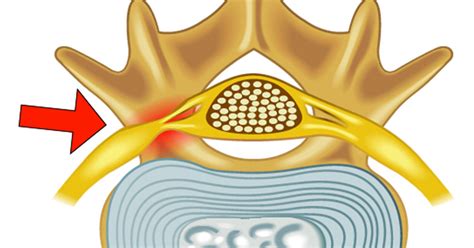 Spinal narrowing foraminal narrowing spinal stenosis