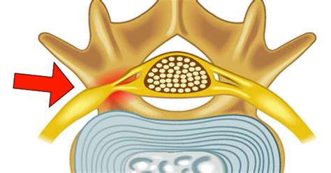 Foraminal Stenosis Lake Charles La Spine And Brain Surgery Dr