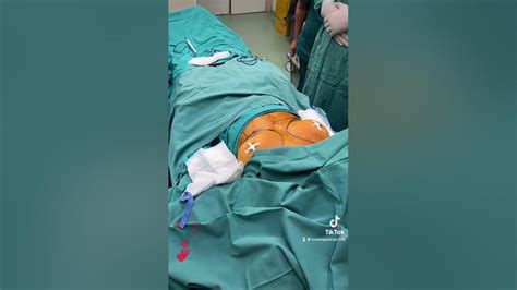 Breast Augmentation By 400cc Roundhigh Profile Gel Silicone Implants Youtube