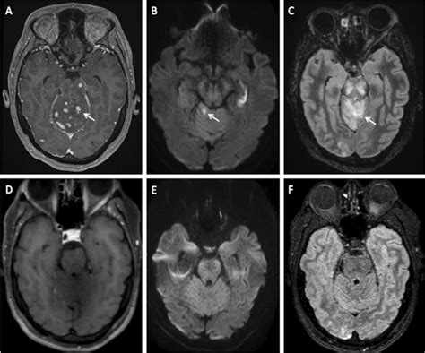 patient 3 imaging features patient 3 a brain mr gadolinium enhanced download scientific