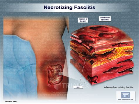 Necrotizing Fasciitis Trial Exhibits Inc