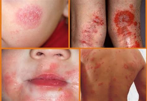 Dermatite At Pica O Que Voc Precisa Saber Dra Janaina Melo