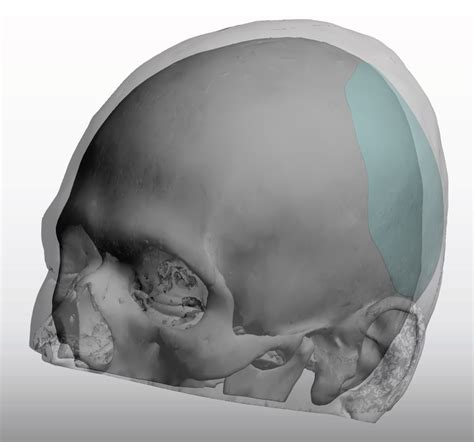 Left Custom Skull Implant For Plagiocephaly Oblique View Scalp