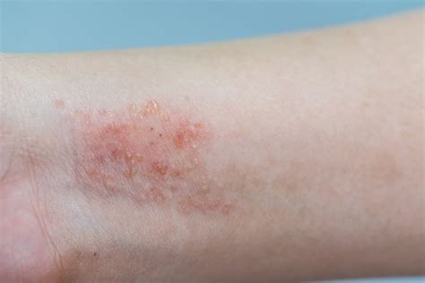 Dermatite Ce Que C Est Les Diff Rents Types Et Comment Les Traiter Avec Photos Tua Sa De