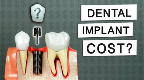 Dental Implant Bangalore Implant Dental Implants Tooth Implant