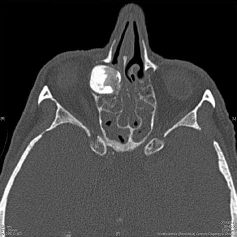 Giant Fronto‐ethmoidal Osteoma Selection Of An Optimal Surgical