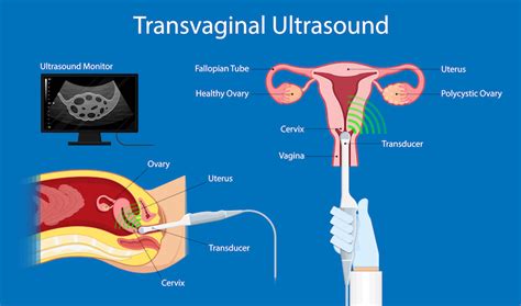Transvaginal Ultrasound Medlineplus Medical Encyclopedia Image Sexiz Pix
