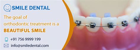 Fixed Braces Treatment In Dilsukhnagar Smile Dental