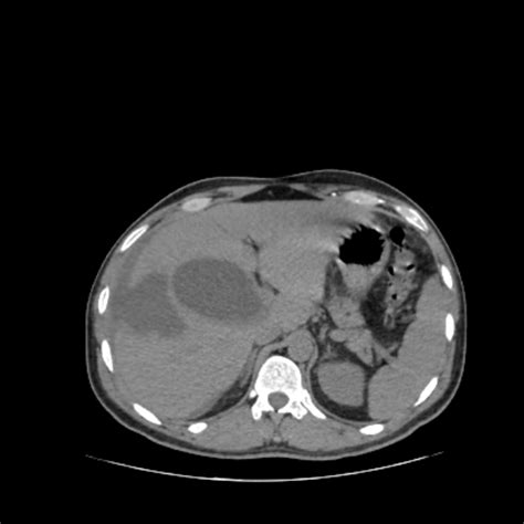 Spontaneous Intraperitoneal Rupture Of Hepatic Hydatid Cyst Image
