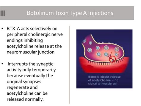 Botulinum Toxin Type A Injections