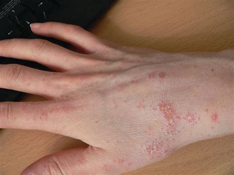 Scabies On Hands