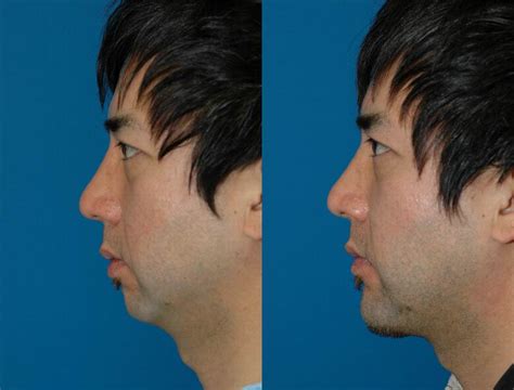 Chin Implant Seattle Chin Augmentation Genioplasty