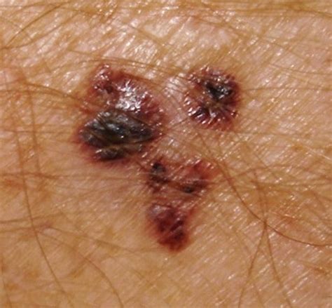 What Does Melanoma Look Like And Could Your Mole Be Skin Cancer