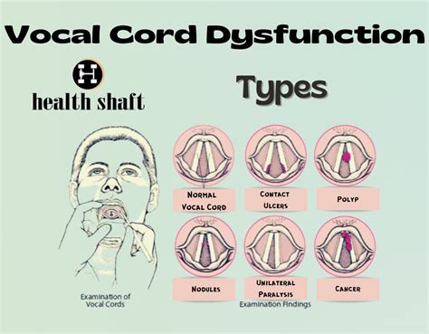 Everything About Vocal Cord Dysfunction And Asthma Health Shaft