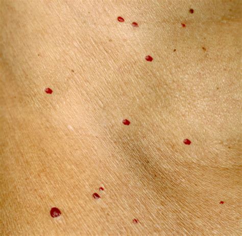 Pinpoint Red Dots On Skin Treatment Cupkurt