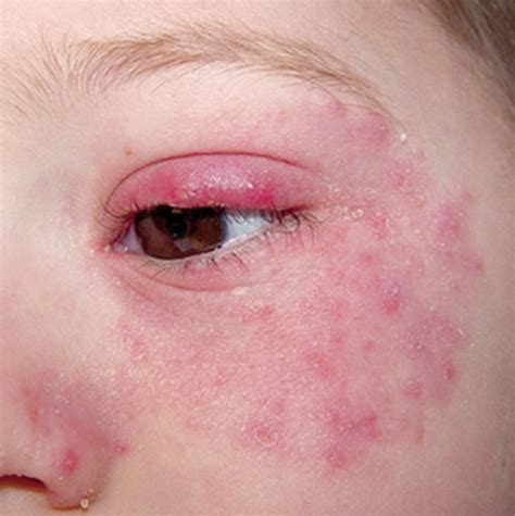 eczema around eyes new health guide