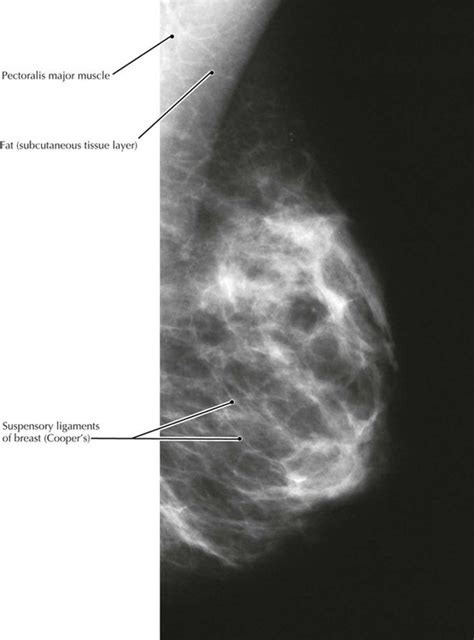 Dimpling of breast skin is often reported in the setting of breast cancer malignancy. Thorax | Radiology Key