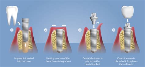 Single Tooth Dental Implants Newport News Va