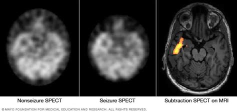 Epilepsy Diagnosis And Treatment Mayo Clinic