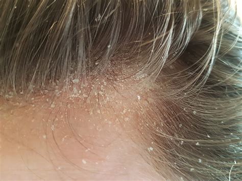 In other words, this kind of eczema can trigger and cause hair loss, particularly true if the affected area is hairy skin. Lost in the Oyster: Scalp Eczema