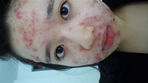At the moment there are three fda approved birth control pills for acne. My Acne Story - Birth Control Pills (For Accutane) - YouTube