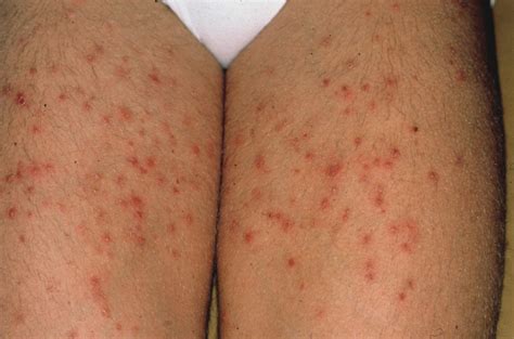 Folliculitis Acute Bacterial Bockharts Impetigo Superficial