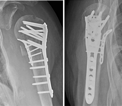 Displaced Proximal Humeral Fracture Control Group Angular Stable