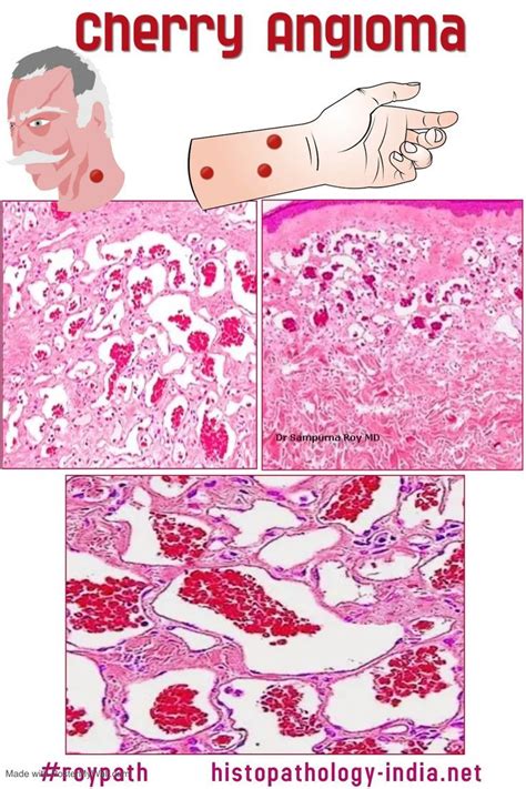 Pathology Of Cherry Angioma Senile Angioma Campbell De Morgan Spots