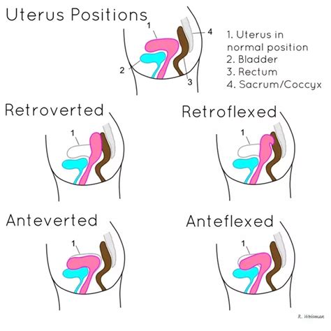 pin by admirable jewels on ultrasound notes diagnostic medical sonography retroverted uterus