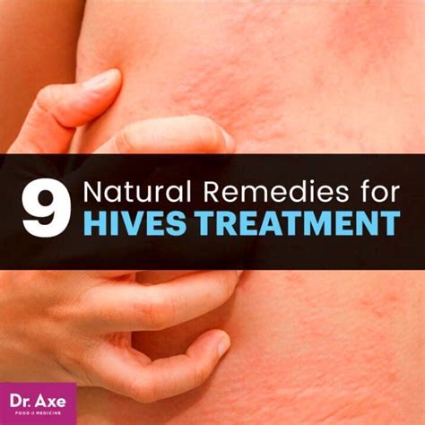 Natural Allergies Remedies For Kids Simple Urticaria Or Hives Are