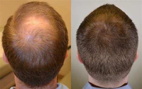 Hair Loss Pictures Before After