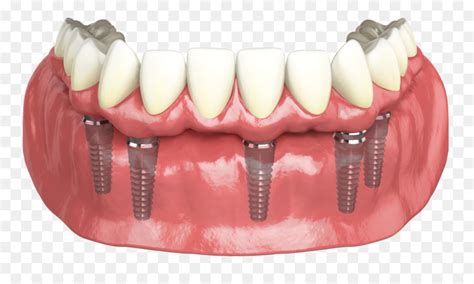 Hybridge Implants Dentaires Dentiste Implant Dentaire Png Hybridge