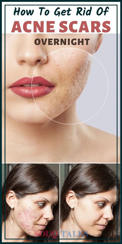 Pin On Acne Scars Before And After